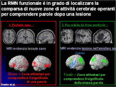 Immagine RMN: nuove zone di attività cerebrale
