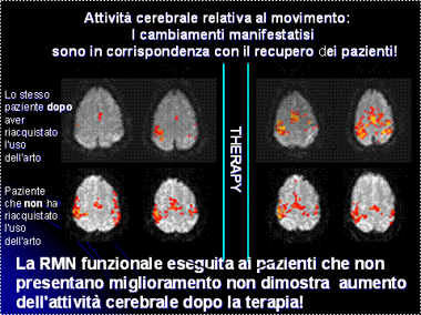 Immagini RMN: aumento attività cerebrale dopo terapia